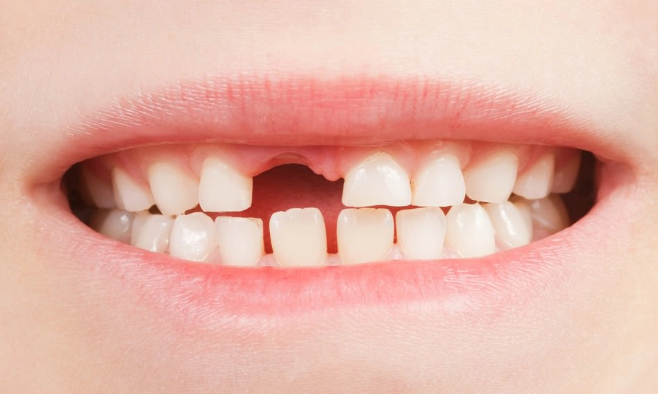 Teeth Bust Urgent Care: What to Do if You Break a Tooth.